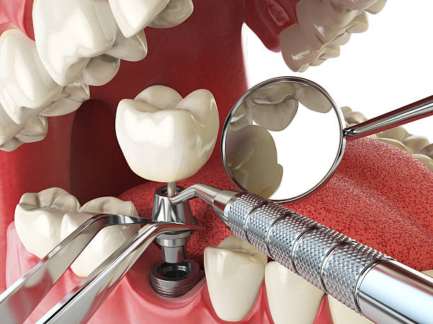 Best Broken Tooth Emergency  in Lookout Mountain, GA